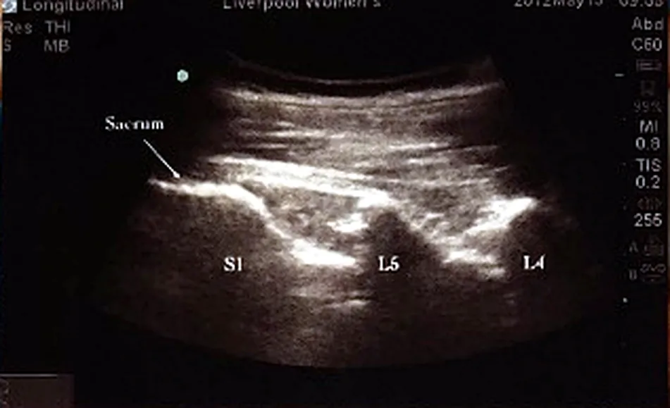 Sacrum, then S1, L5 and L4 counted upwards.