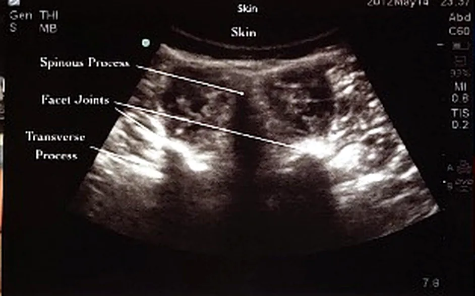 Spinous process, facet joints and transverse processes in transverse section.