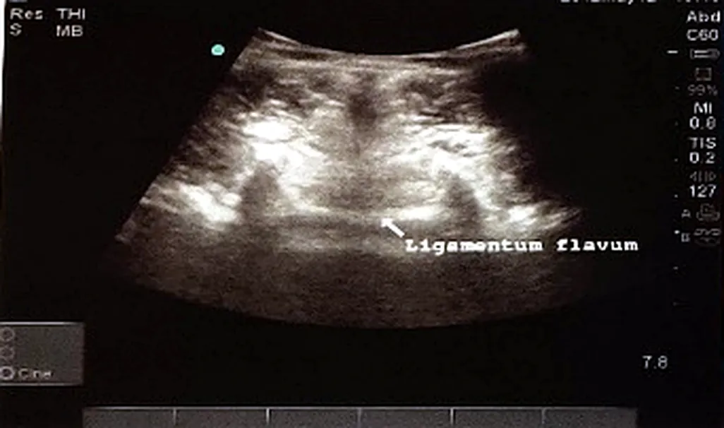 Symmetrical inter-space view with the ligamentum flavum labelled.